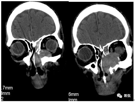 73岁患者因左鼻塞流脓涕4个月入院，CT发现一软组织高低混杂密度，怎么诊断？