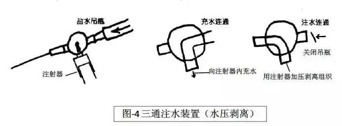 术后腹壁窦道怎样处理,腹部窦道手术怎么判断切除干净