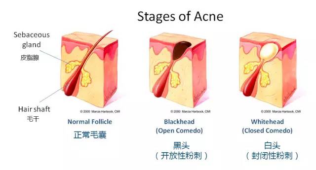 长痘痘怎么才能不留印,长痘痘了怎么消除不留疤