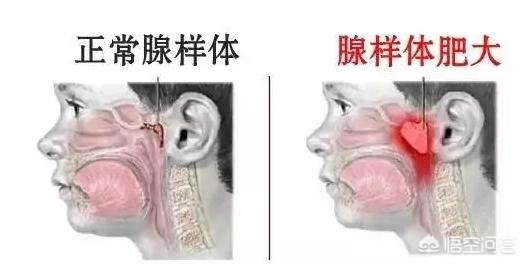 孩子睡不好很容易被忽视,孩子睡觉打鼾是什么原因怎么解决
