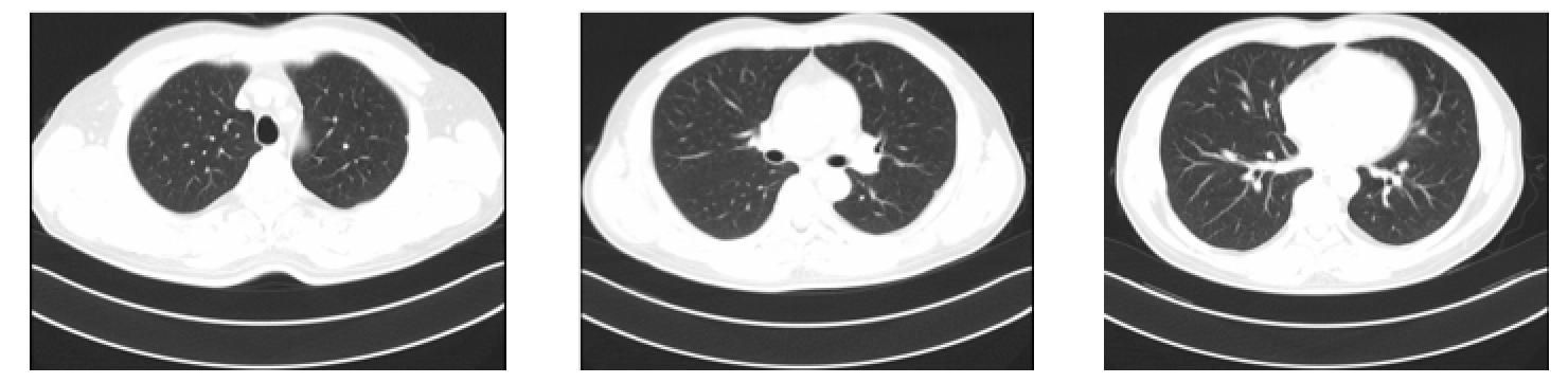 直肠腺癌肺转移最好的治疗方案,得了直肠腺癌不治疗能活几年
