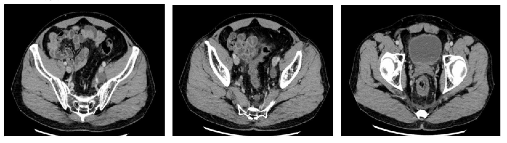 直肠腺癌肺转移最好的治疗方案,得了直肠腺癌不治疗能活几年