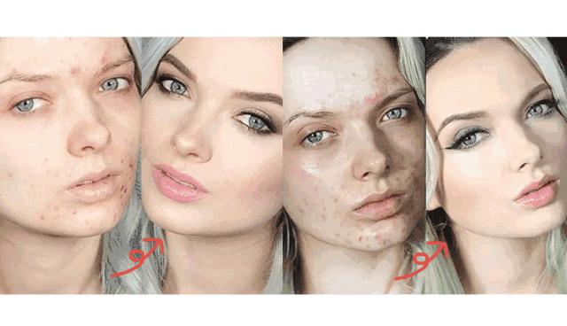 脸一换季就过敏长痘干痒,换季过敏脸上长闭口痘痘