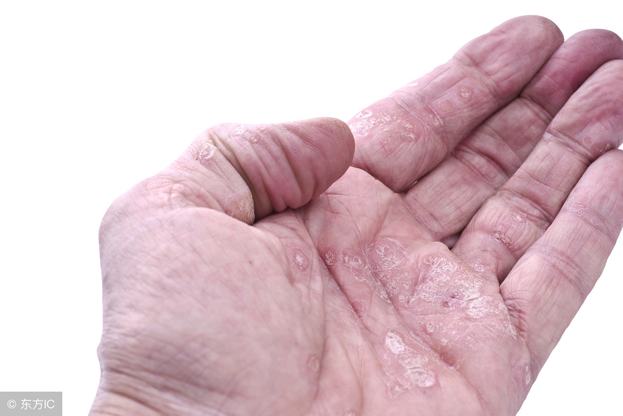 银屑病用他卡西醇和地奈德,银屑病他卡西醇