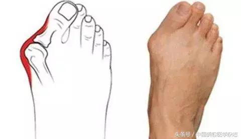 大脚拇指外翻矫正治疗,大脚骨拇指外翻真的能矫正好吗