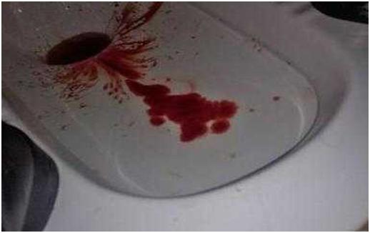 痔疮破裂便血怎么治疗,痔疮便血后身体发虚