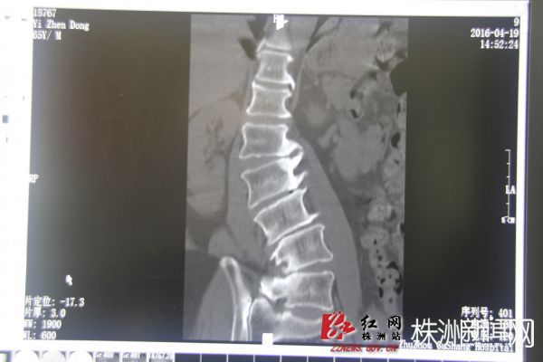 老人脊柱侧弯1到10度图片,老人脊柱侧弯矫正视频