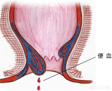 痔疮比较严重可以不做手术吗,痔疮很严重如果不做手术会怎么样