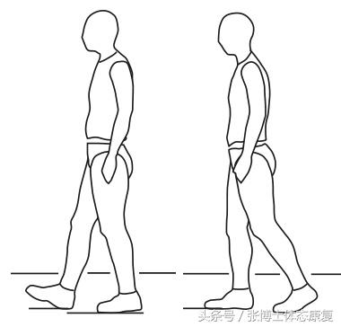 acl韧带重建手术后遗症,acl前交叉韧带重建第9天