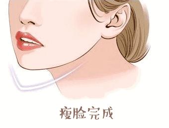 瘦脸针注意事项禁忌,瘦脸针的使用方法及注意事项