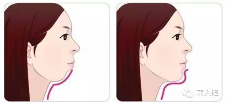 第一次整容日记,整容日记最经典的一段