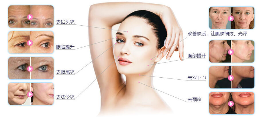 超声刀对抗岁月的神器,超声刀有哪些版本