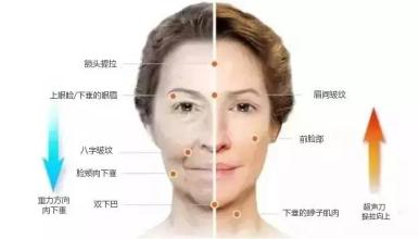 超声刀抗衰老真的有那么神奇吗,超声刀真的能抗老