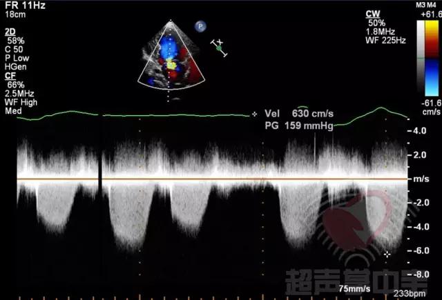 二尖瓣充血性囊肿,二尖瓣血性囊肿是什么意思