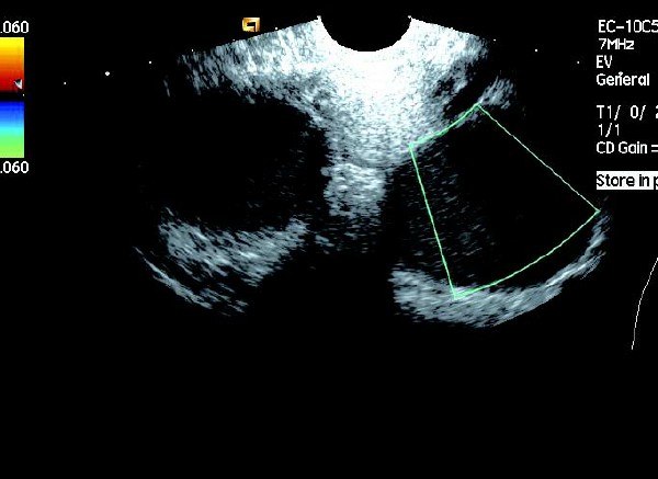 卵巢巧克力囊肿彩超描述,卵巢巧克力囊肿的超声诊断要点