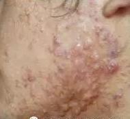 痘印的种类及成因,红色痘印成因