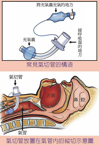 气管切开术急救切哪里,气道切开急救