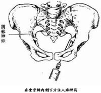 顺产侧切有什么影响？如何恢复已经全部总结验收？