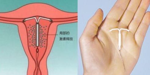 你被强迫上环了吗？请善待你老婆的身体，看了想骂人！