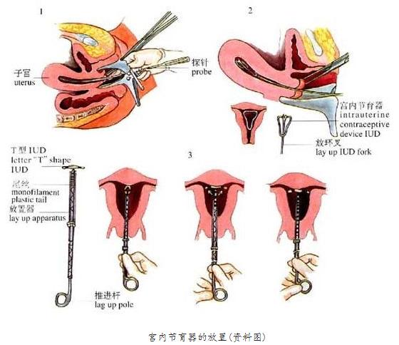 现代女性戴环过程痛苦吗,妇女戴环是啥样的