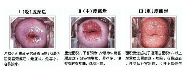 宫颈糜烂伴有宫颈炎可以备孕吗,宫颈糜烂治疗期间容易怀孕吗