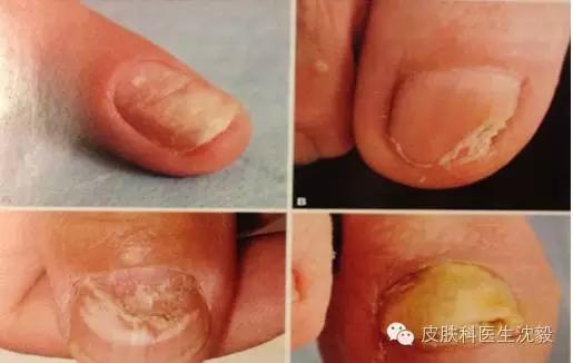 以为是灰指甲结果指甲掉了,得了灰指甲不管它行吗