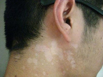 治汗斑有什么土方法,汗斑可以彻底治好吗