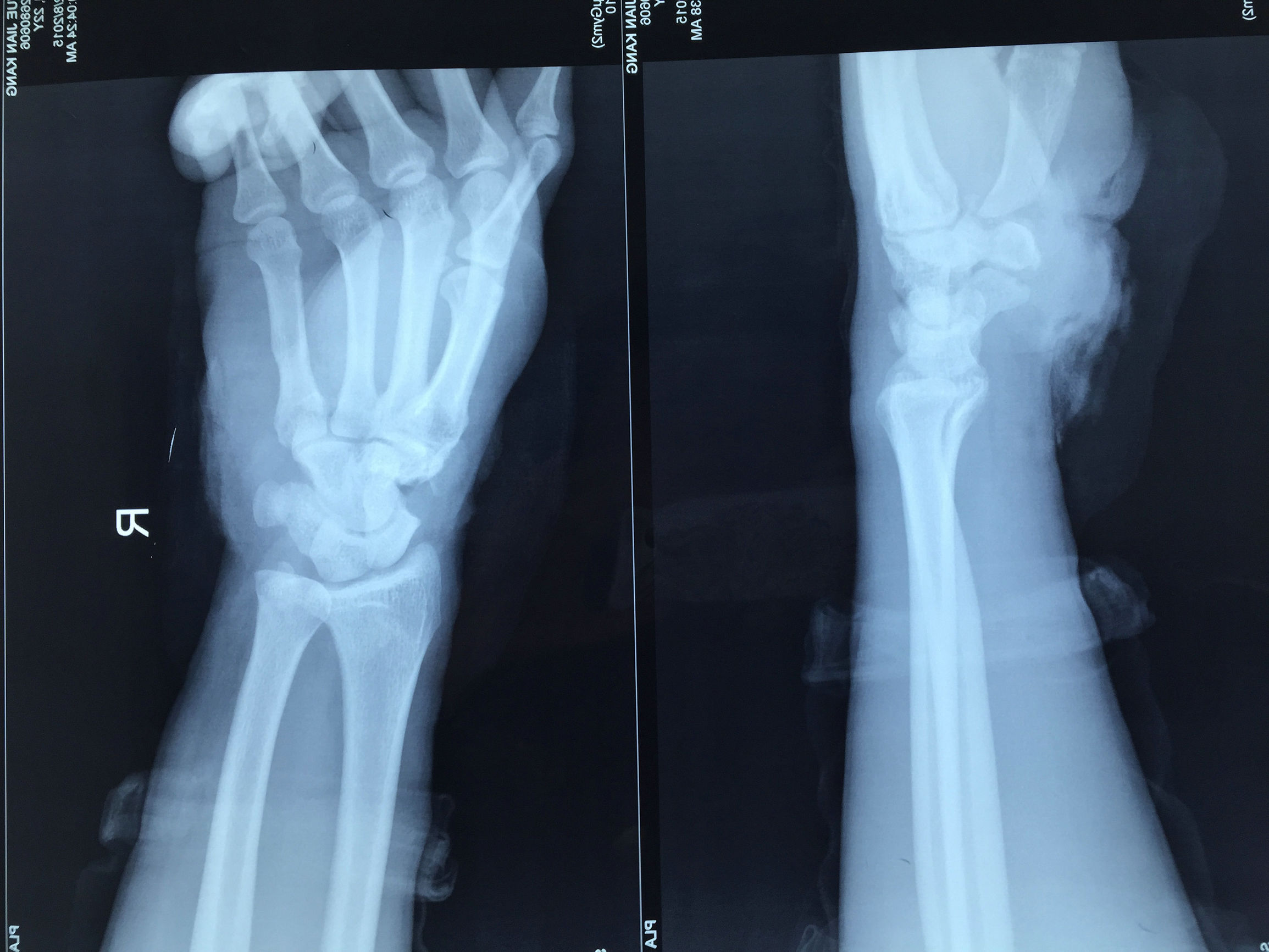 306医院骨科专家谈电锯伤手的处理