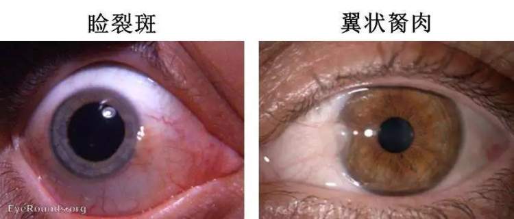 小孩眼红流泪有眼屎用什么滴眼液,孩子眼红有眼屎眼睛痒怎么办