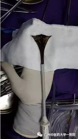 「女科荟」快速去内膜，保留子宫！诺舒，一种治疗月经过多的微创新方法