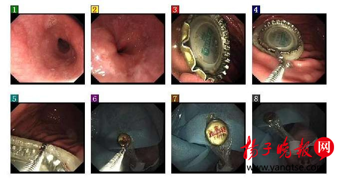男子喝啤酒太猛吞下瓶盖医生借助“套套”将盖子取出