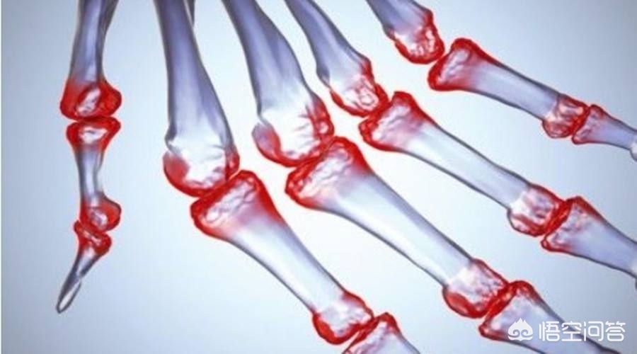 间质性肺炎病因是不是很难找,间质性肺炎的严重程度判断依据