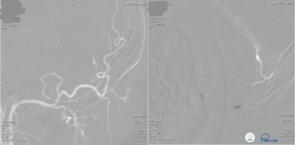 球囊辅助Onyx栓塞治疗硬脑膜动静脉瘘（DAVF）