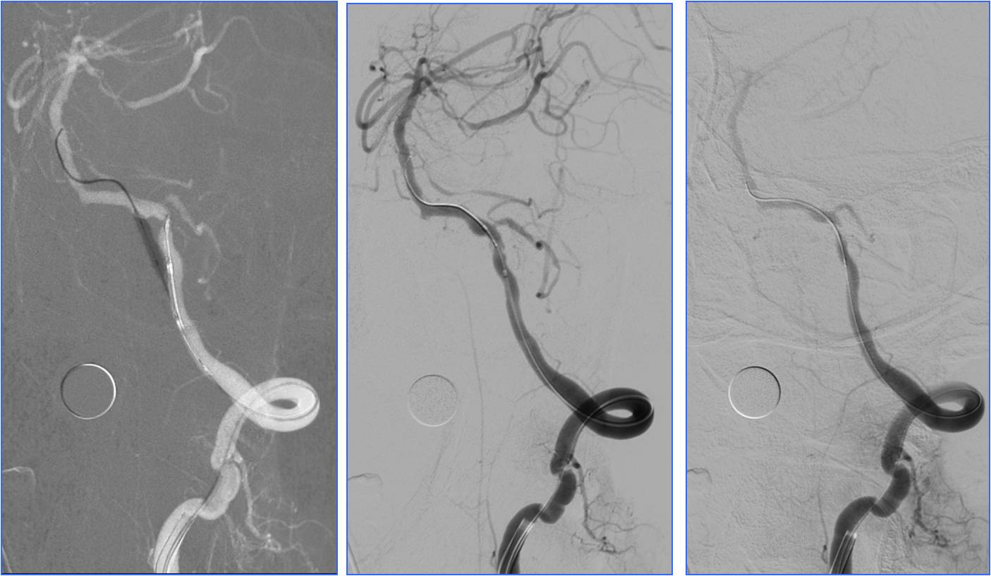 缺血性脑卒中术后管理,急性缺血性脑卒中血管内治疗