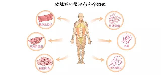 肉瘤良性和恶性误诊大不大,肉瘤为什么误诊为息肉