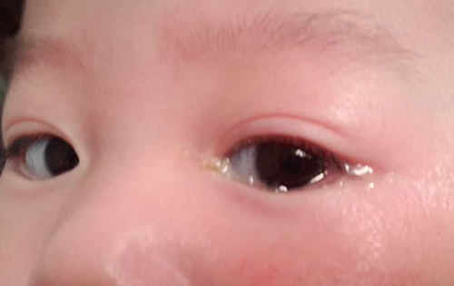 眼睛一直出眼屎是上火还是炎症,眼睛红有眼屎是哪里上火了么