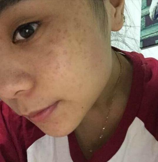 男人脸上长斑怎么办如何快速祛斑,老年人脸上祛斑美白