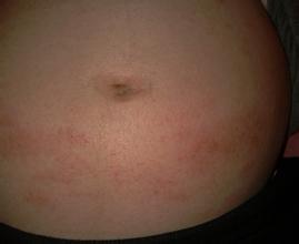 夏季如何防晒保护皮肤,孕妇要怎么护理皮肤