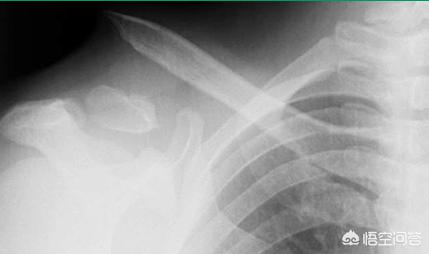 小孩骨折警惕四种表现,小孩骨折需要注意哪些