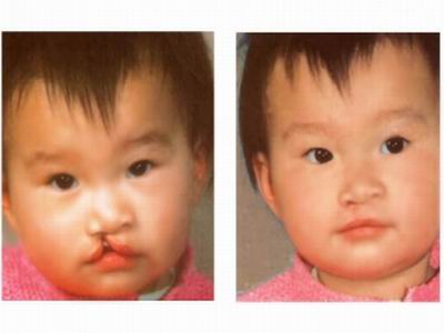 新生儿轻微兔唇是怎么造成的,生娃防坑指南