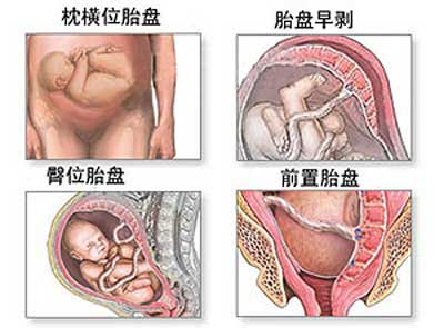 剖腹产没有想象中的那么可怕,剖腹产手术中的真实感受