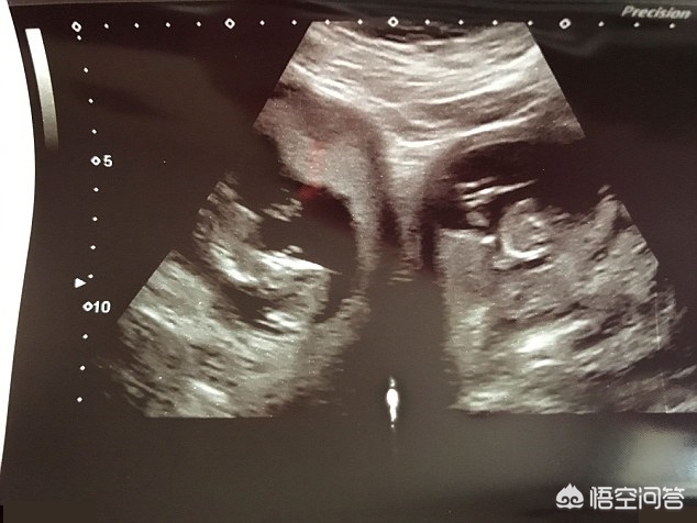 双子宫都能怀孕吗,双子宫双胞胎需要减胎吗