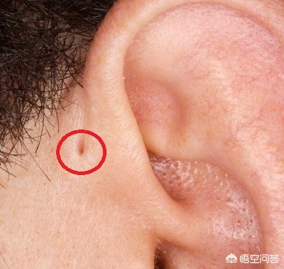 有些人耳朵有一个小洞,有的人耳朵上为什么有小洞洞