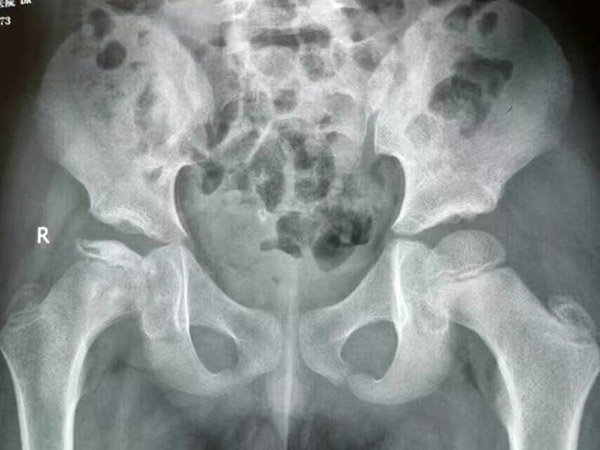 儿童股骨头坏死，“不治自愈”的传言不要再信了!