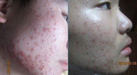 中医能有多厉害把恶疮治好了,老中医治疮秘方