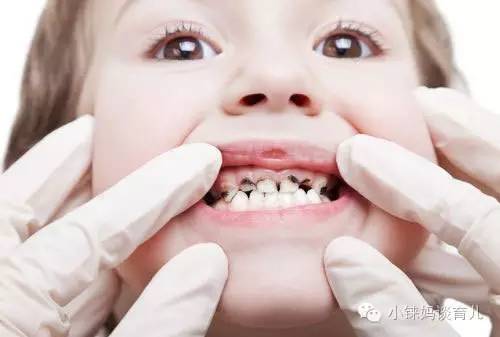 乳牙掉了没牙根怎么补牙,儿童乳牙龋齿烂了有必要补牙吗