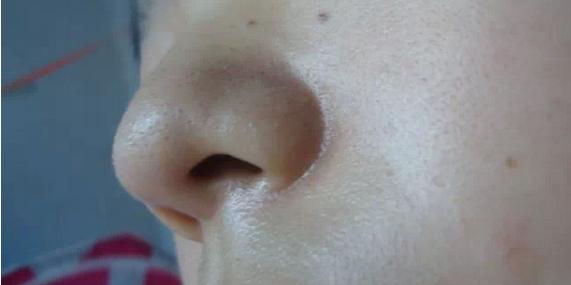 为什么皮肤毛孔粗大,毛孔粗大的真正原因到底是什么