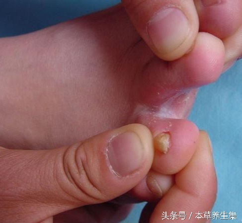 脚脱皮长水泡是哪种真菌感染,趾间糜烂型脚气穿过的鞋怎么处理