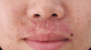 毛孔粗大真的没有办法可以救吗,毛孔粗大就不能再收缩了吗