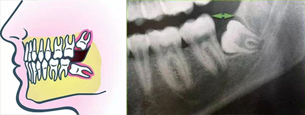 智齿发炎烦恼,智齿含牙囊肿需要尽早拔除吗